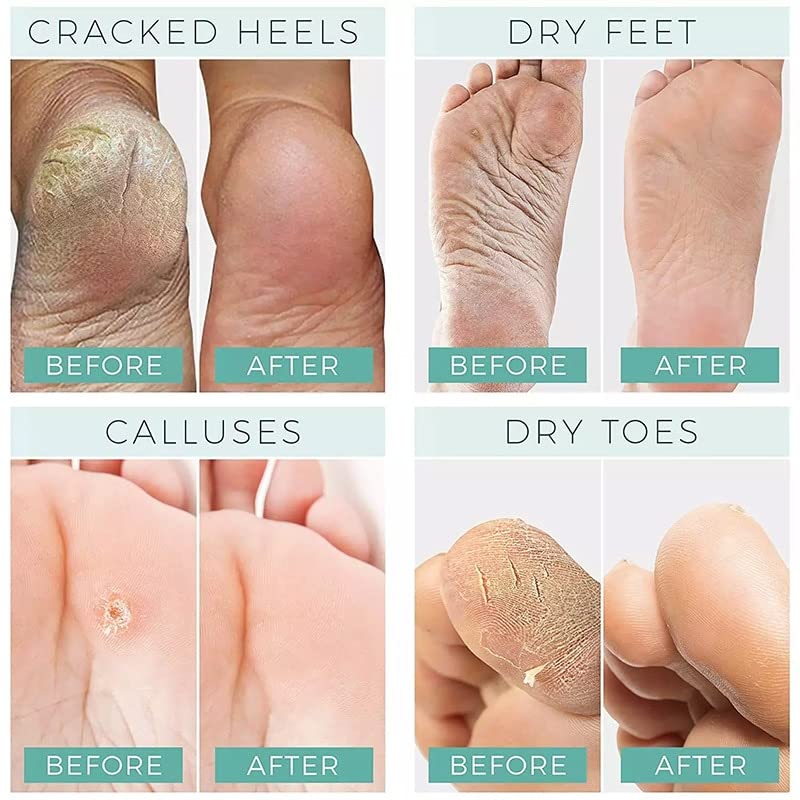 Skinge Anti Crack Urerea Feot Feet Feel Máscara Remoção de pele Dead Salto REPARO Cracked Glicerina Mãos Branquear Produtos de Cuidado Hidratante
