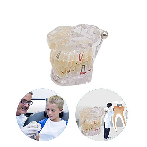 Modelo de dentes dentários Modelo de implante de dente transparente Modelo periodontal Modelo de dente móvel Bom para demonstração