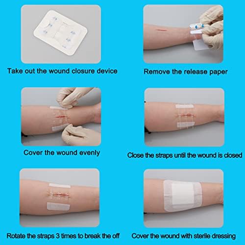 Longmed Emergency Ferlure tiras de tiras de borboleta bandagens costuras suturas bandagens adesivas para reparo de laceração com zíper de primeiros socorros sem pontos para cuidados com a ferida