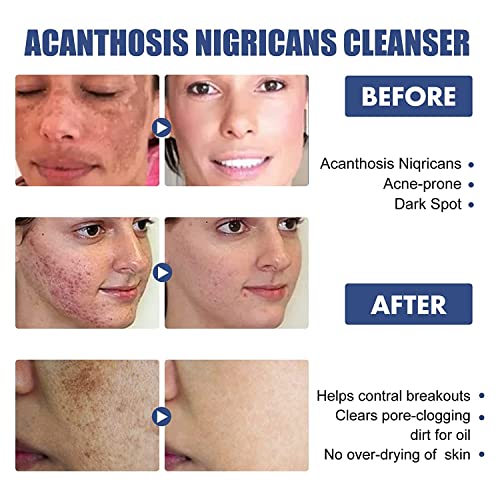 Loção de limpeza para acne e manchas e acanthose nigricans, lavagem corporal de salyzap de 50 ml, acanthose nigrie nigricans terapia creme