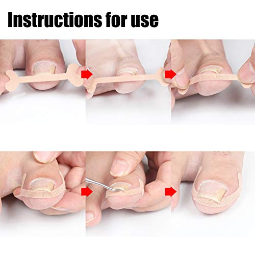 Correção de unhas Patches de ponta do dedo do pé de ponta dos dedos da alça de alça de alça para a saúde da unha para as unhas das unhas encravadas para correção de unhas para uso doméstico